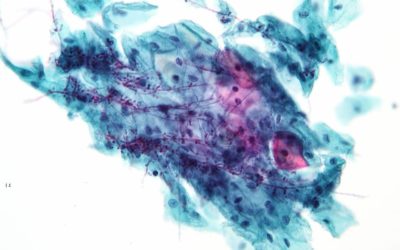 Candida albicans: Wissen zu Symptomen und mehr